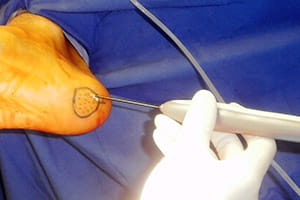 Fascitis plantar