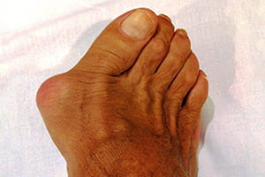 Hallux valgus (Juanete)