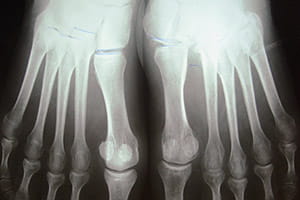Lesiones de la articulación de Lisfranc