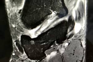 Lesiones del tendón tibial posterior
