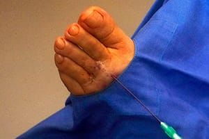 Neuroma de Morton