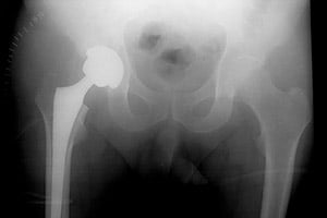 Artrosis de cadera (Coxartrosis)