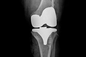 Artrosis de rodilla (Gonartrosis)