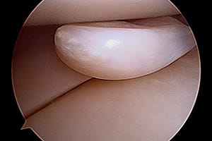 Lesiones meniscales