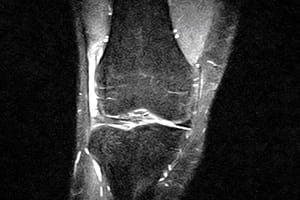 Síndrome de la cintilla iliotibial (Rodilla del corredor)