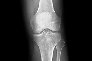 Rotura del ligamento cruzado anterior de la rodilla