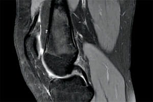 Rotura del ligamento cruzado posterior de la rodilla